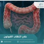 علاج التهاب القولون