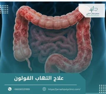 علاج التهاب القولون
