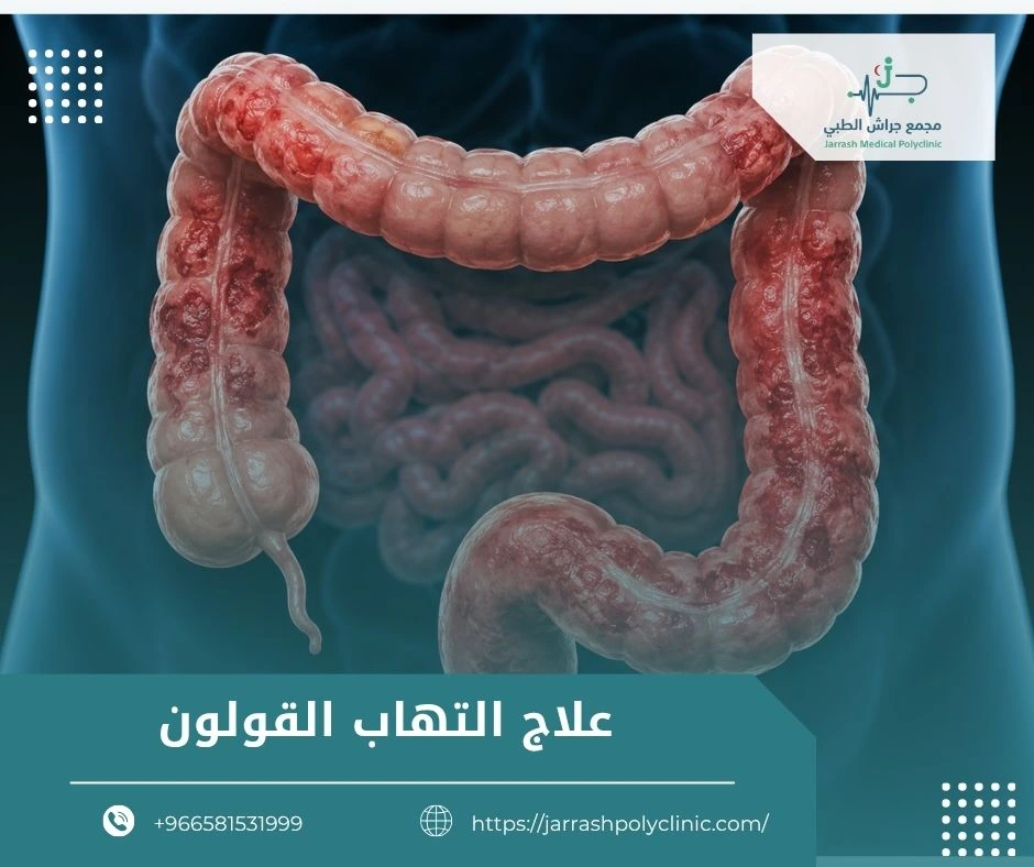 علاج التهاب القولون