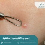 اسباب الاكياس الدهنية