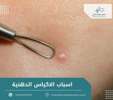 اسباب الاكياس الدهنية