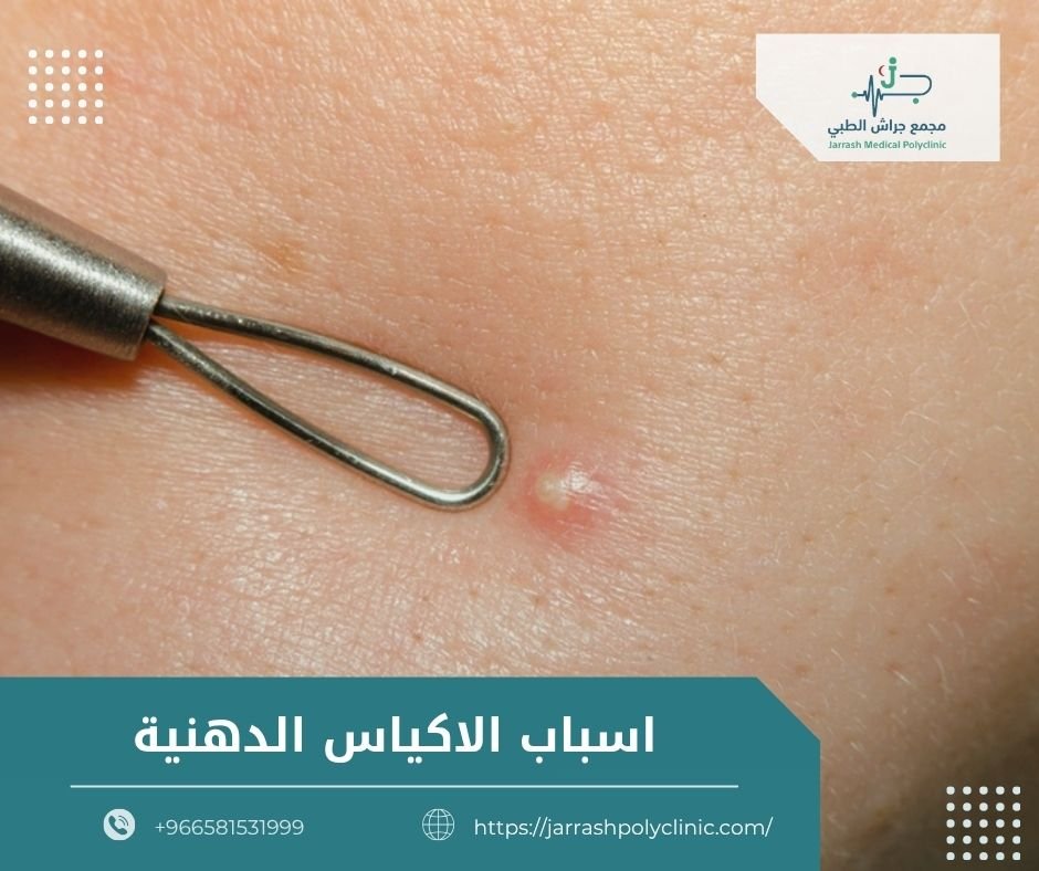 اسباب الاكياس الدهنية