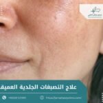 علاج التصبغات الجلدية العميقة