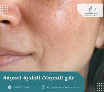 علاج التصبغات الجلدية العميقة
