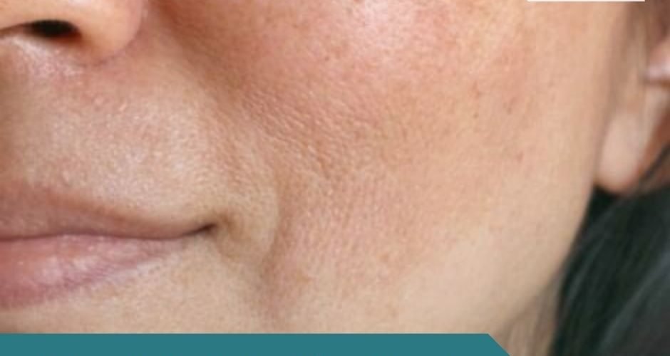 علاج التصبغات الجلدية العميقة