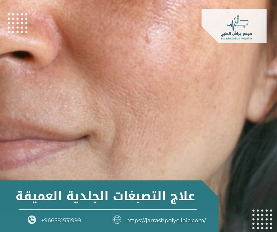 علاج التصبغات الجلدية العميقة