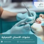 حشوات الاسنان التجميلية