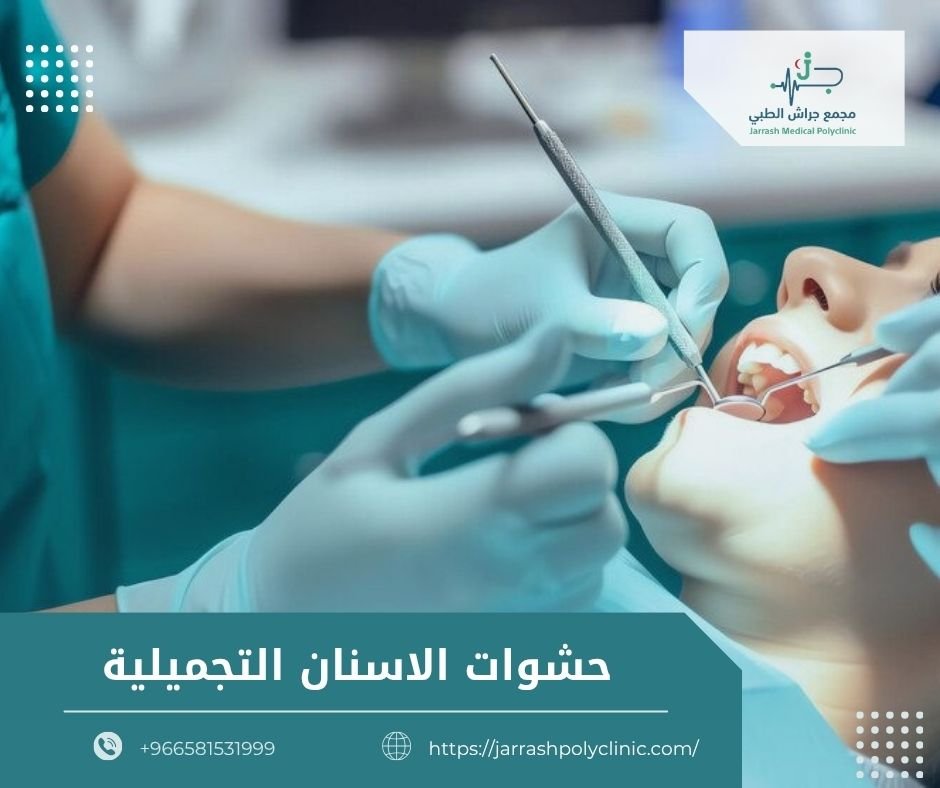 حشوات الاسنان التجميلية