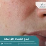 علاج المسام الواسعة