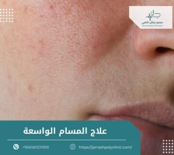 علاج المسام الواسعة