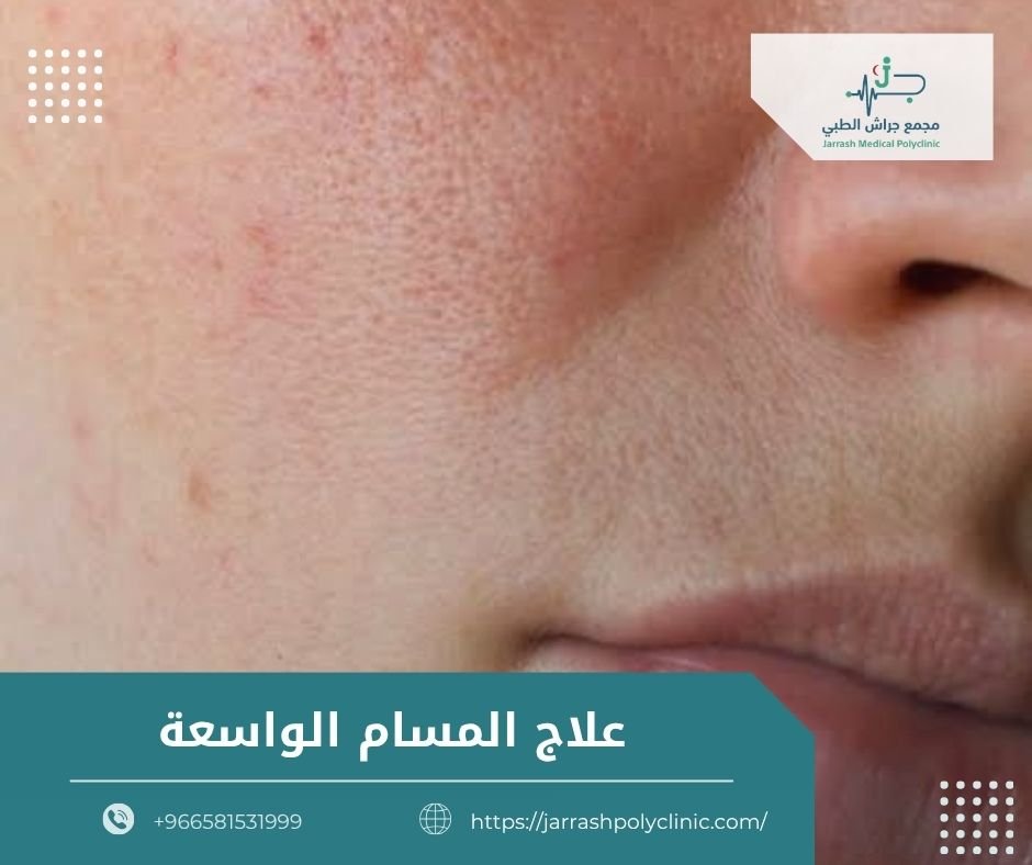 علاج المسام الواسعة